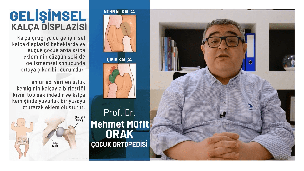 Gelisimsel Kalca Displazisi