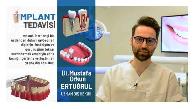 Implant Tedavisi